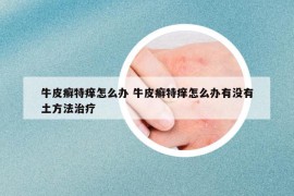 牛皮癣特痒怎么办 牛皮癣特痒怎么办有没有土方法治疗