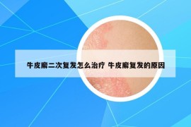 牛皮廨二次复发怎么治疗 牛皮廨复发的原因
