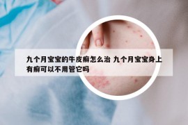 九个月宝宝的牛皮癣怎么治 九个月宝宝身上有癣可以不用管它吗