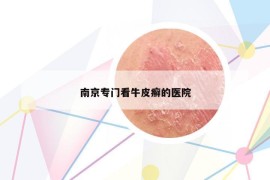 南京专门看牛皮癣的医院