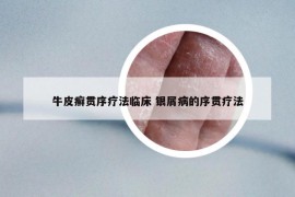 牛皮癣贯序疗法临床 银屑病的序贯疗法
