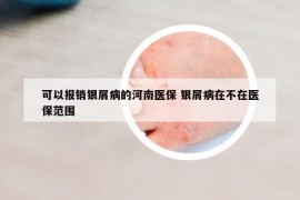 可以报销银屑病的河南医保 银屑病在不在医保范围