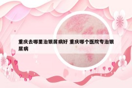 重庆去哪里治银屑病好 重庆哪个医院专治银屑病