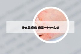 什么是癣病 癣是一种什么病