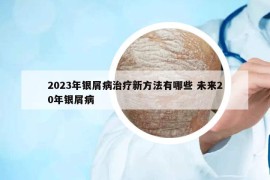 2023年银屑病治疗新方法有哪些 未来20年银屑病