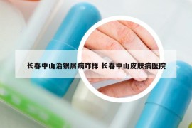 长春中山治银屑病咋样 长春中山皮肤病医院
