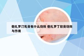 他扎罗汀乳膏有什么功效 他扎罗丁软膏功效与作用