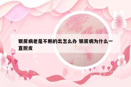 银屑病老是不断的出怎么办 银屑病为什么一直脱皮
