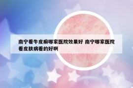 南宁看牛皮癣哪家医院效果好 南宁哪家医院看皮肤病看的好啊