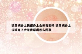 银屑病身上拔罐身上会无青紫吗 银屑病身上拔罐身上会无青紫吗怎么回事