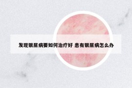 发现银屑病要如何治疗好 患有银屑病怎么办