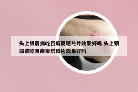 头上银屑病吃百癣夏塔热片效果好吗 头上银屑病吃百癣夏塔热片效果好吗