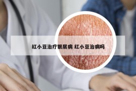 红小豆治疗银屑病 红小豆治病吗