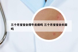 三个月宝宝会得牛皮癣吗 三个月宝宝会长藓吗