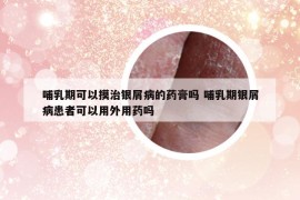哺乳期可以摸治银屑病的药膏吗 哺乳期银屑病患者可以用外用药吗