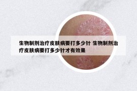 生物制剂治疗皮肤病要打多少针 生物制剂治疗皮肤病要打多少针才有效果