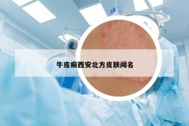 牛皮癣西安北方皮肤闻名