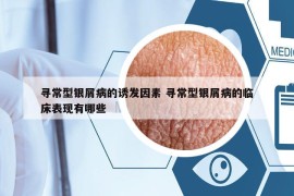 寻常型银屑病的诱发因素 寻常型银屑病的临床表现有哪些