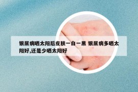银屑病晒太阳后皮肤一白一黑 银屑病多晒太阳好,还是少晒太阳好