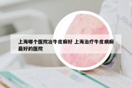 上海哪个医院冶牛皮癣好 上海治疗牛皮病癣最好的医院