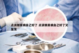 点滴银屑病自己好了 点滴银屑病自己好了又复发