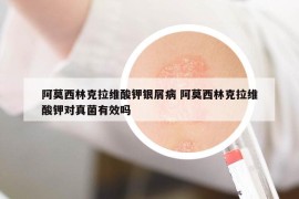 阿莫西林克拉维酸钾银屑病 阿莫西林克拉维酸钾对真菌有效吗
