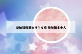 华陂镇哪里治疗牛皮癣 华陂镇多少人