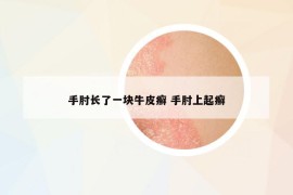 手肘长了一块牛皮癣 手肘上起癣