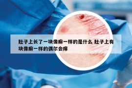 肚子上长了一块像癣一样的是什么 肚子上有块像癣一样的偶尔会痒