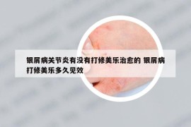 银屑病关节炎有没有打修美乐治愈的 银屑病打修美乐多久见效