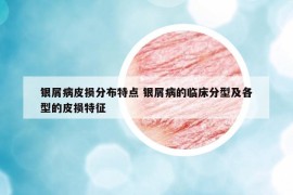 银屑病皮损分布特点 银屑病的临床分型及各型的皮损特征