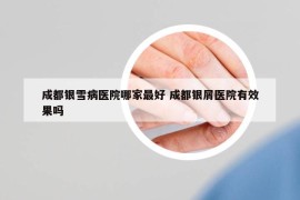 成都银雪病医院哪家最好 成都银屑医院有效果吗