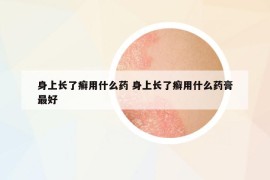 身上长了癣用什么药 身上长了癣用什么药膏最好