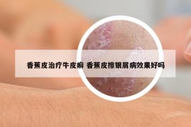 香蕉皮治疗牛皮癣 香蕉皮擦银屑病效果好吗