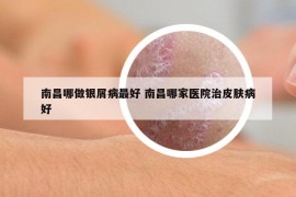 南昌哪做银屑病最好 南昌哪家医院治皮肤病好