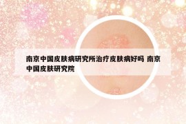 南京中国皮肤病研究所治疗皮肤病好吗 南京中国皮肤研究院