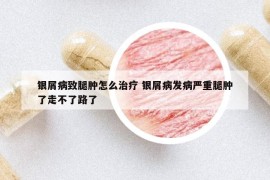 银屑病致腿肿怎么治疗 银屑病发病严重腿肿了走不了路了