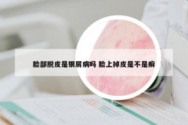 脸部脱皮是银屑病吗 脸上掉皮是不是癣