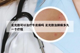 足光散可以治疗牛皮癣吗 足光散治脚癣多久一个疗程