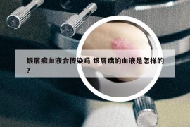 银屑癣血液会传染吗 银屑病的血液是怎样的?
