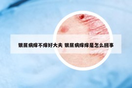 银屑病痒不痒好大夫 银屑病痒痒是怎么回事