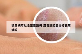 银屑病可以吃湿毒清吗 湿毒清胶囊治疗银屑病吗