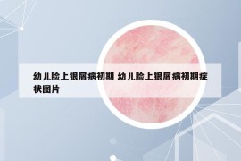 幼儿脸上银屑病初期 幼儿脸上银屑病初期症状图片