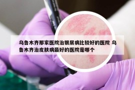 乌鲁木齐那家医院治银屑病比较好的医院 乌鲁木齐治皮肤病最好的医院是哪个