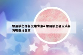 银屑病怎样补充维生素a 银屑病患者应该补充哪些维生素