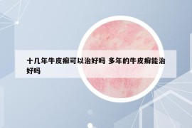十几年牛皮癣可以治好吗 多年的牛皮癣能治好吗