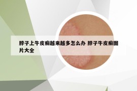 脖子上牛皮癣越来越多怎么办 脖子牛皮癣图片大全