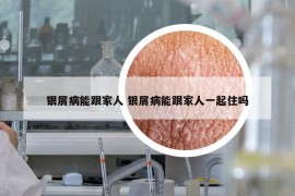 银屑病能跟家人 银屑病能跟家人一起住吗