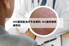 301医院能治疗牛皮癣吗 301医院银屑病专科