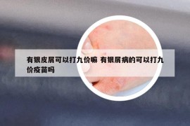 有银皮屑可以打九价嘛 有银屑病的可以打九价疫苗吗